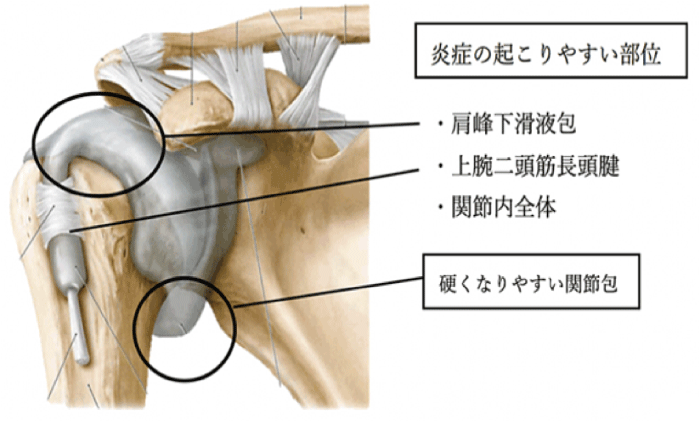 肩関節周囲炎 四十肩 五十肩 整体 鍼灸なら実績と信頼の メディカルジャパン立川