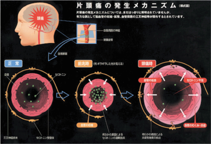 頭痛 整体 鍼灸なら実績と信頼の メディカルジャパン新宿 新宿駅徒歩1分
