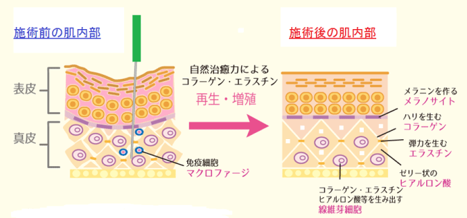 美容鍼(公式LINE) – 立川No.1実績｜選ばれる整体・鍼灸院｜メディカルジャパン立川