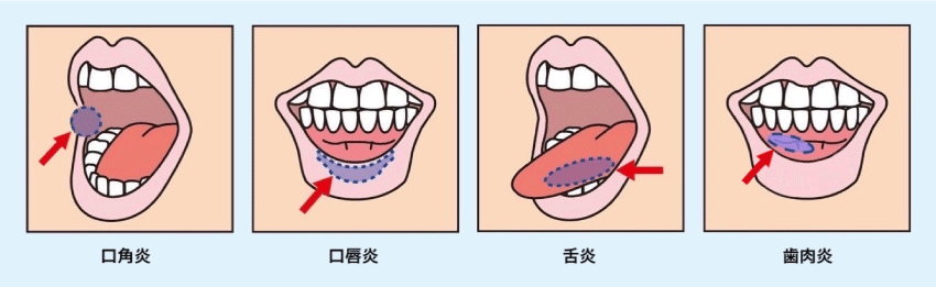 口内炎 整体 鍼灸なら実績と信頼の メディカルジャパン立川