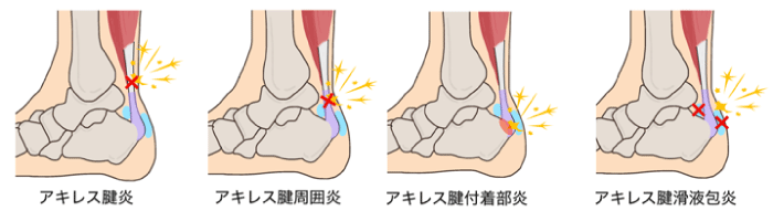 アキレス腱炎 | 新宿No.1実績｜選ばれる整体・鍼灸院｜メディカルジャパン新宿