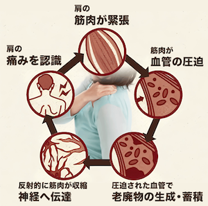 痛みの悪循環図