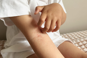 アトピー性皮膚炎